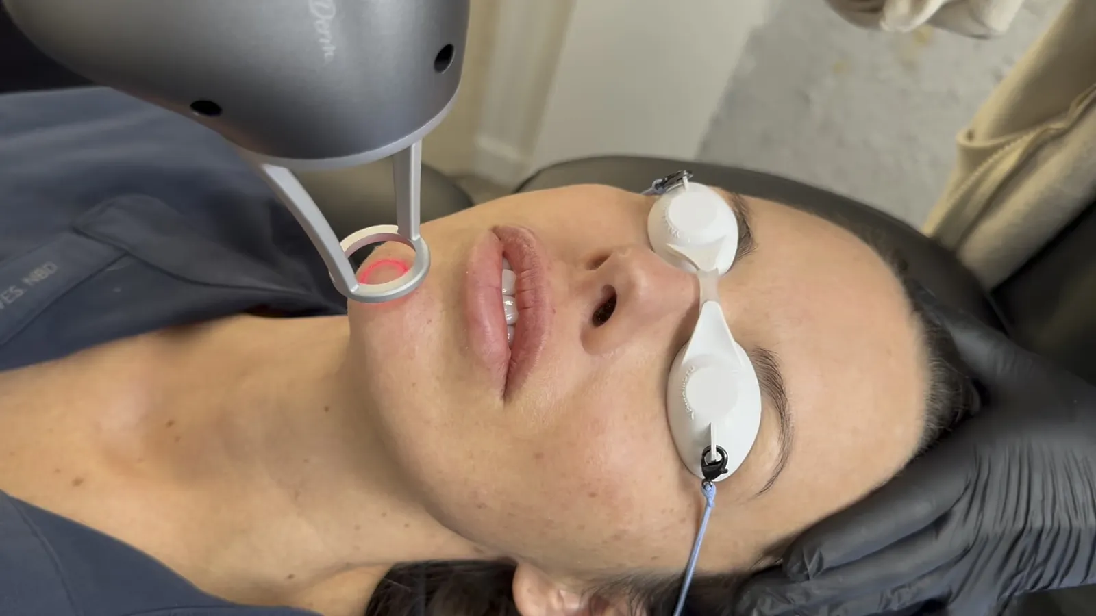 NouvaDerm laser